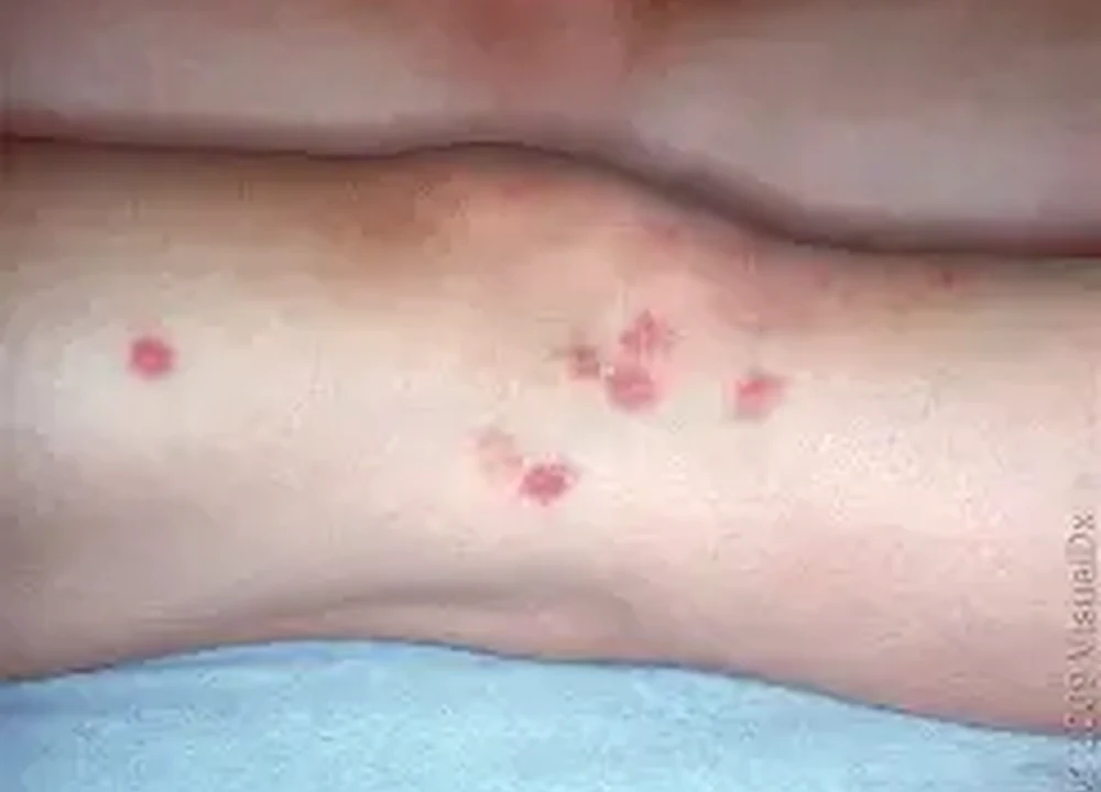 Realistic photo of red bite reactions on an arm used as a bed bug bite education example