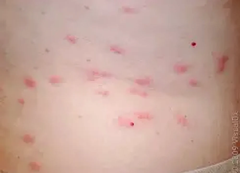 Realistic photo of multiple red bite reactions on skin used as a bed bug bite education example